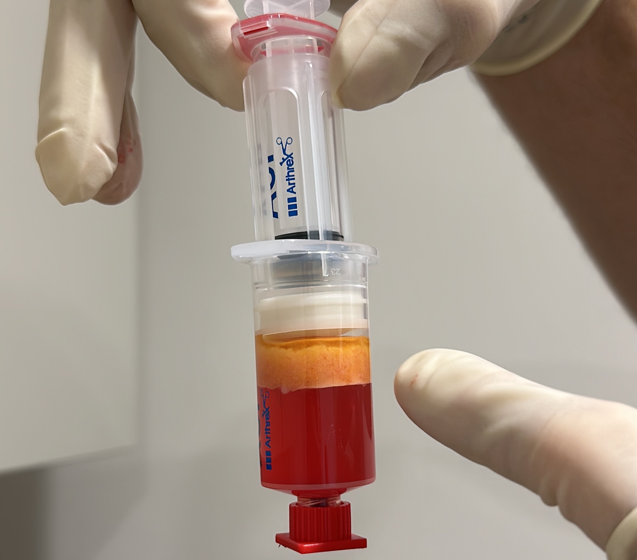 Fettstamm­zellentherapie Arthrose